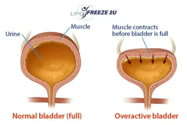 diagram of overactive bladder treatment Edmonton