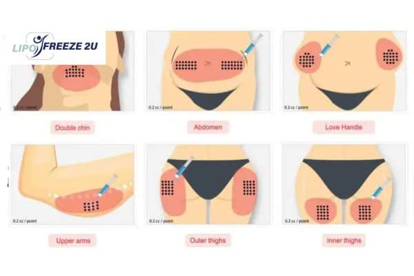 Benefits of Choosing Aqualyx for Fat Reduction Edmonton