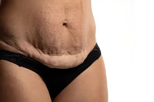 loose skin after weight loss injections Edmonton