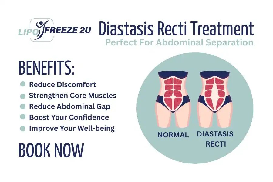 Benefits of body toning treatment Edmonton for Diastasis recti