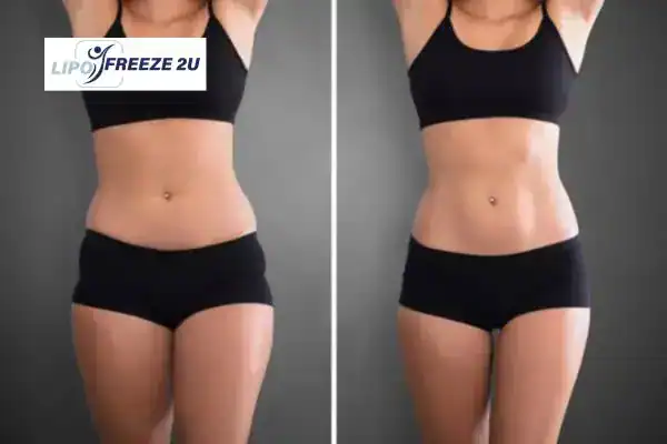 How Can LIPO FREEZE 2U Support Your Post-Pregnancy Body Recovery Edmonton?