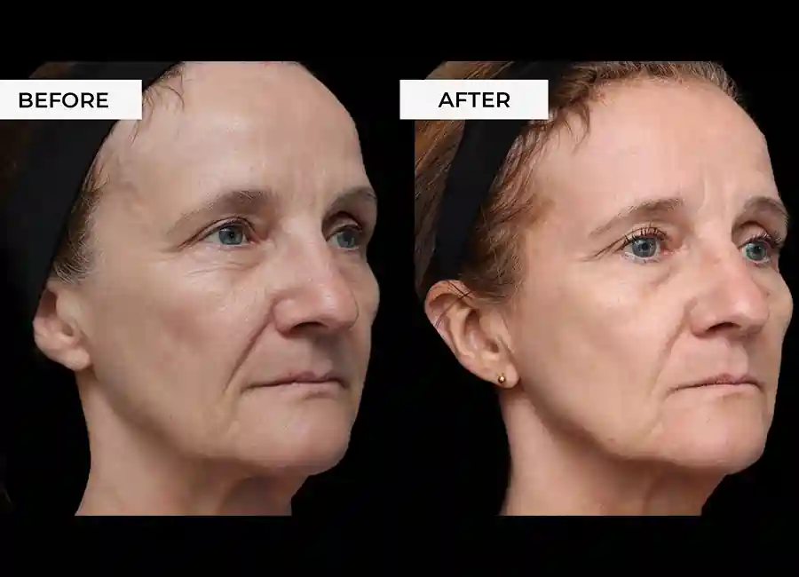 How Many RF Microneedling Sessions Will You Need to See a Difference Edmonton?