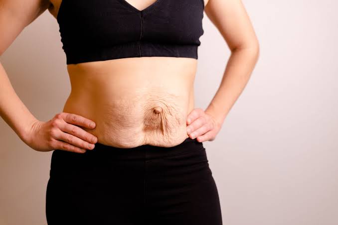 Is Surgery Really the Only Way to Repair Diastasis Recti Edmonton?