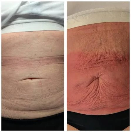 How Does RF Microneedling Improve Crepey, Thin and Uneven Skin Texture Edmonton?