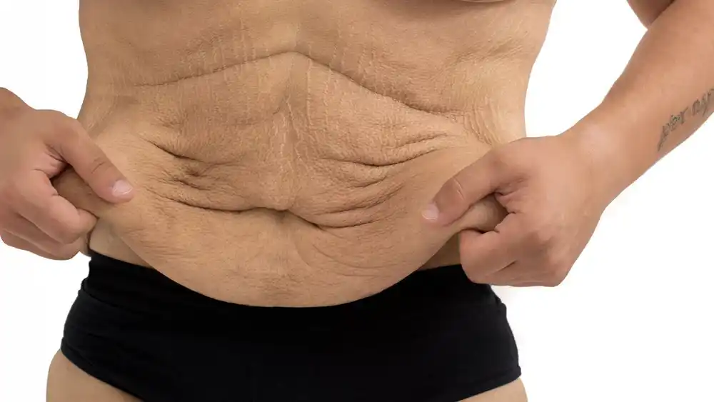 Why Does Weight Loss Medication Leave Some People With Loose or Sagging Skin Edmonton?